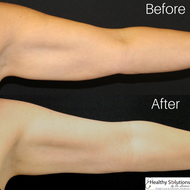 HlthySolMedSpa's tweet image. Don't be afraid of that holiday wave! Say hello without the worry of that under arm jiggle! ⁠
⁠
That's right - @coolsculpting at @healthysolutionsmedspa can help that stubborn under-arm fat cells that we can't seem to shake. ⁠
⁠
Call us today for a FREE consultation!