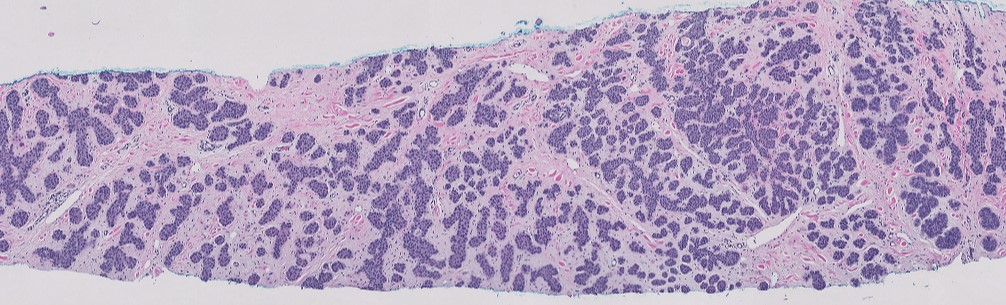 JRamirezMD's tweet photo. Basal cell carcinoma, micronodular type: The micronodular pattern was mostly in the deep portion of the specimen, with more conventional areas superficially.  This variant can be more aggressive... #dermpath #dermatology #pathology https://t.co/UvSsDZQh6m