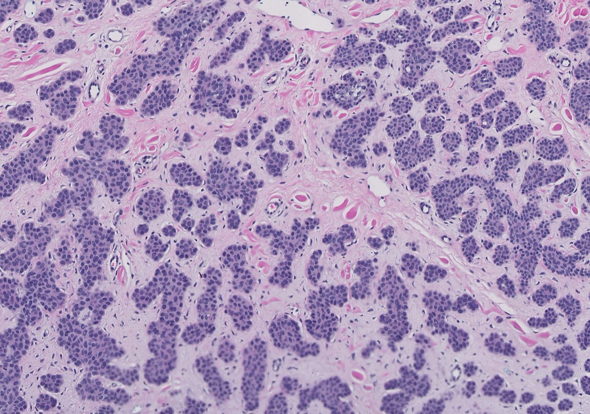 JRamirezMD's tweet photo. Basal cell carcinoma, micronodular type: The micronodular pattern was mostly in the deep portion of the specimen, with more conventional areas superficially.  This variant can be more aggressive... #dermpath #dermatology #pathology https://t.co/UvSsDZQh6m