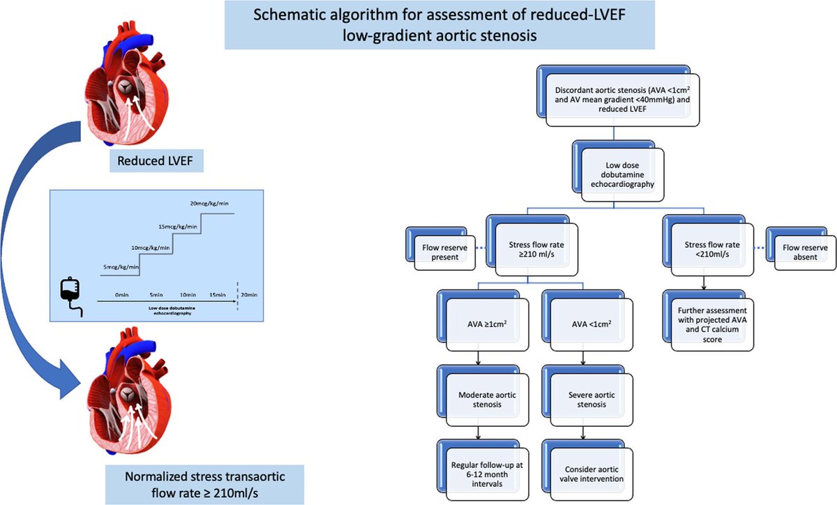 Kardiologie MedUni Wien Forschung (@kardiologiewien) on Twitter photo Clinical Value of Stress Transaortic Flow Rate During Dobutamine Echocardiography in Reduced LVEF, Low-Gradient Aortic Stenosis:
ImportantMulticenter Study with support from our <a href="/KardiologieWien/">Kardiologie MedUni Wien Forschung</a> <a href="/BerglerKlein/">Jutta Bergler-Klein</a> <a href="/pe_bartko/">Philipp E. Bartko</a> <a href="/m_koschutnik/">Matthias Koschutnik</a>
ahajournals.org/doi/full/10.11… Clinical Value of Stress Transaortic Flow Rate During Dobutamine Echocardiography in Reduced LVEF, Low-Gradient Aortic Stenosis:
ImportantMulticenter Study with support from our <a href="/KardiologieWien/">Kardiologie MedUni Wien Forschung</a> <a href="/BerglerKlein/">Jutta Bergler-Klein</a> <a href="/pe_bartko/">Philipp E. Bartko</a> <a href="/m_koschutnik/">Matthias Koschutnik</a>
ahajournals.org/doi/full/10.11…