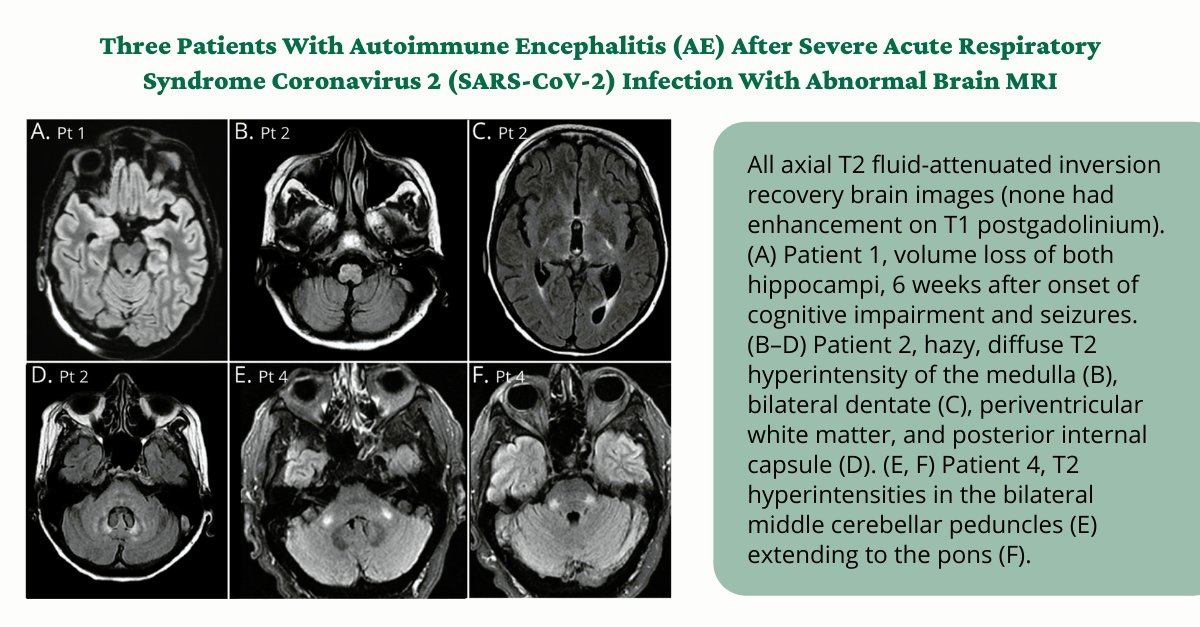 GreenJournal's tweet photo. Autoimmune Encephalitis After SARS-CoV-2 Infection: Case Frequency, Findings, and Outcomes https://t.co/KIKzlf3hev #COVID #Neurology https://t.co/q2Qf7NeJHo
