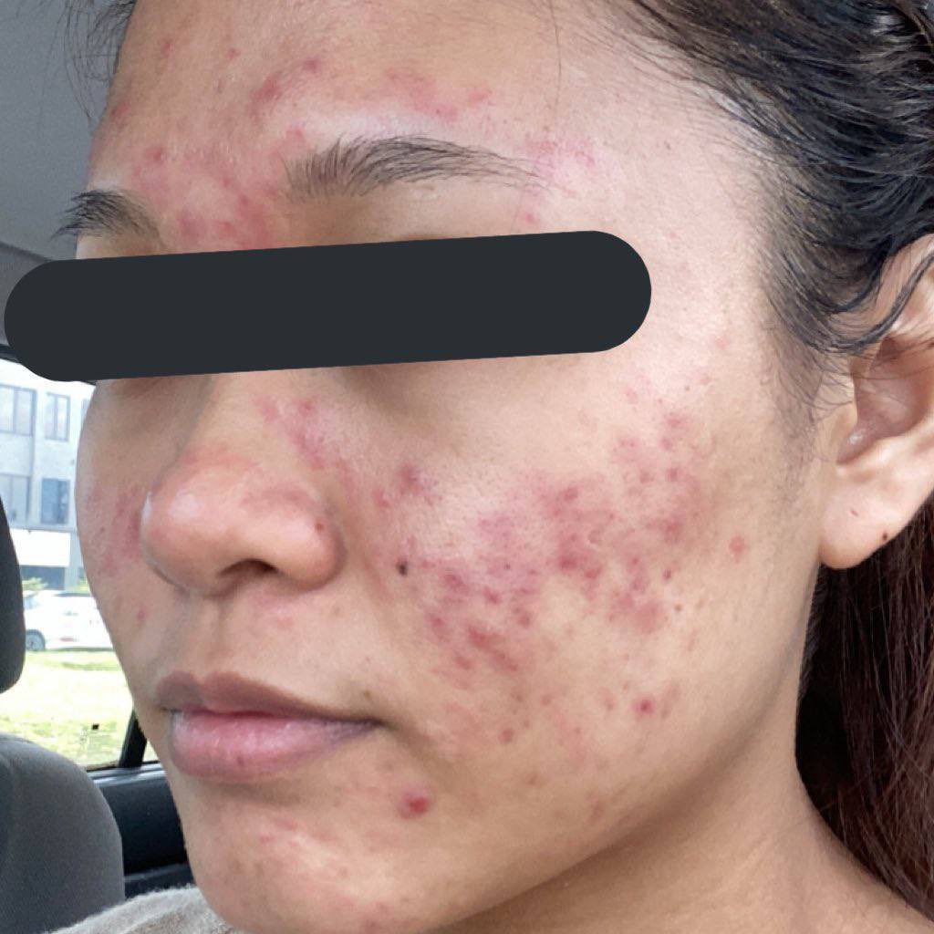 theiceraf's tweet photo. Menyesal lah sebab aku tak beli awal awal dulu. feedback dia padu gila, dahla murah 😭 korang tengoklah habis kecut jerawat dia kerjakan! 

baik beli sekarang tengah sale ni link: https://t.co/YovZsMamIS

Before:                  after: https://t.co/y6MWr53aKz