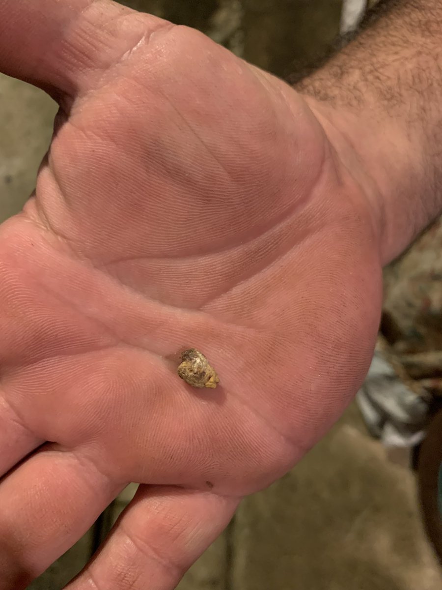 LeonardoSotoMu's tweet photo. Cuando al cuate le sale espontáneamente la piedra, dolor de parto dicen (consentimiento del bro).
#ComandoPhysco
#Urology https://t.co/Qt1NQRyRy8