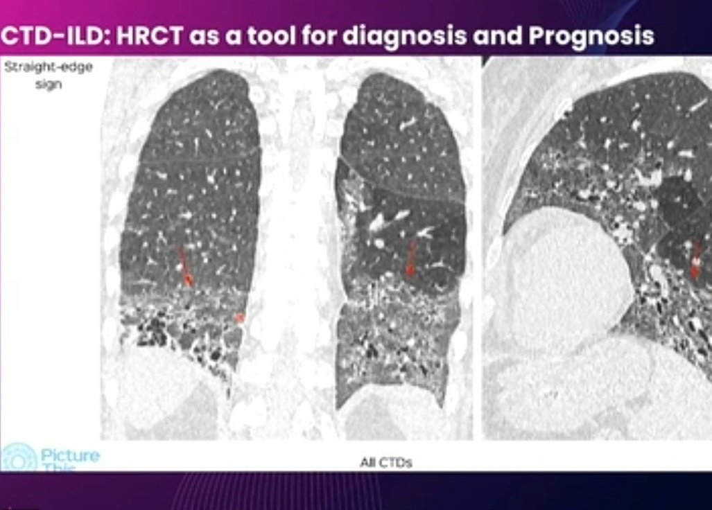 ishaplp's tweet image. @2021Iracon #iracon2021 Informative talk on ILD by Dr Bhavin Jankharia
👉Straight edge sign in CTD ILD not UIP-IPF
👉Island Like fibrosis seen in SLE
👉4Corner sign in Scleroderma
👉Mtx hypersensitivity looks like GGO on background of honeycomb
