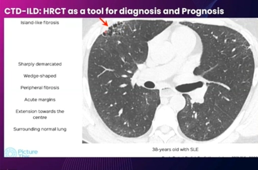 ishaplp's tweet image. @2021Iracon #iracon2021 Informative talk on ILD by Dr Bhavin Jankharia
👉Straight edge sign in CTD ILD not UIP-IPF
👉Island Like fibrosis seen in SLE
👉4Corner sign in Scleroderma
👉Mtx hypersensitivity looks like GGO on background of honeycomb