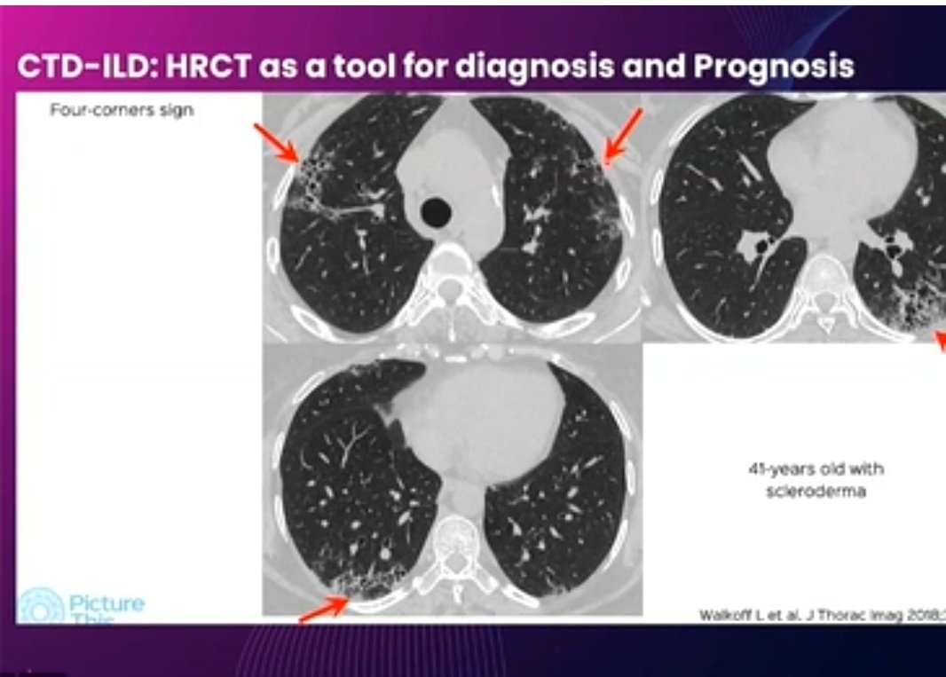 ishaplp's tweet image. @2021Iracon #iracon2021 Informative talk on ILD by Dr Bhavin Jankharia
👉Straight edge sign in CTD ILD not UIP-IPF
👉Island Like fibrosis seen in SLE
👉4Corner sign in Scleroderma
👉Mtx hypersensitivity looks like GGO on background of honeycomb