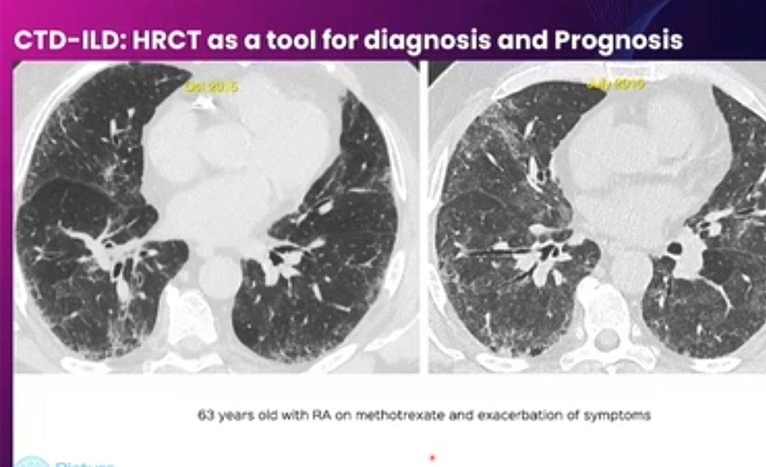 ishaplp's tweet image. @2021Iracon #iracon2021 Informative talk on ILD by Dr Bhavin Jankharia
👉Straight edge sign in CTD ILD not UIP-IPF
👉Island Like fibrosis seen in SLE
👉4Corner sign in Scleroderma
👉Mtx hypersensitivity looks like GGO on background of honeycomb
