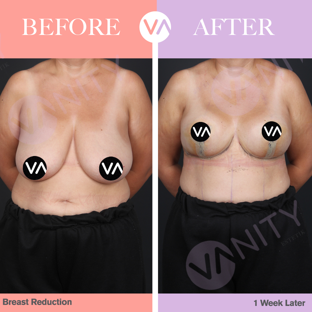 Vanity Cosmetic Surgery on X: Breast sizes that are too large for
