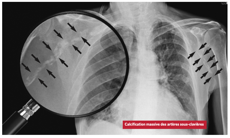 opa_fr's tweet photo. Quand le calcium est sur les vaisseaux... attention aux os ! https://t.co/xLEiar6jUv https://t.co/KQzejvZGvf