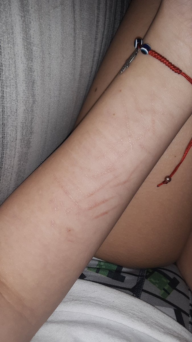 LSER66722307's tweet photo. TW//SH
.
.
.
.
.
.
.
.
.
.
Arm update!!
I've been clean for like 12 days, were gonna change that tonight!
Armgills sh twt raspberryfilling redbreadtwt sliceytwt ouchietwt barcodetwt catscratchestwt https://t.co/Mc5vfYkADF