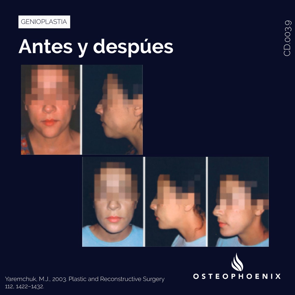 OsteophoenixSL's tweet photo. La mentoplastia permite contornear el mentón para proporcionar una forma anatómica correcta. Mediante los implantes a medida de Osteophoenix se puede generar un dispositivo diseñado exclusivamente para el paciente. https://t.co/7fxM5TMoQV https://t.co/DxnkdKkfBC