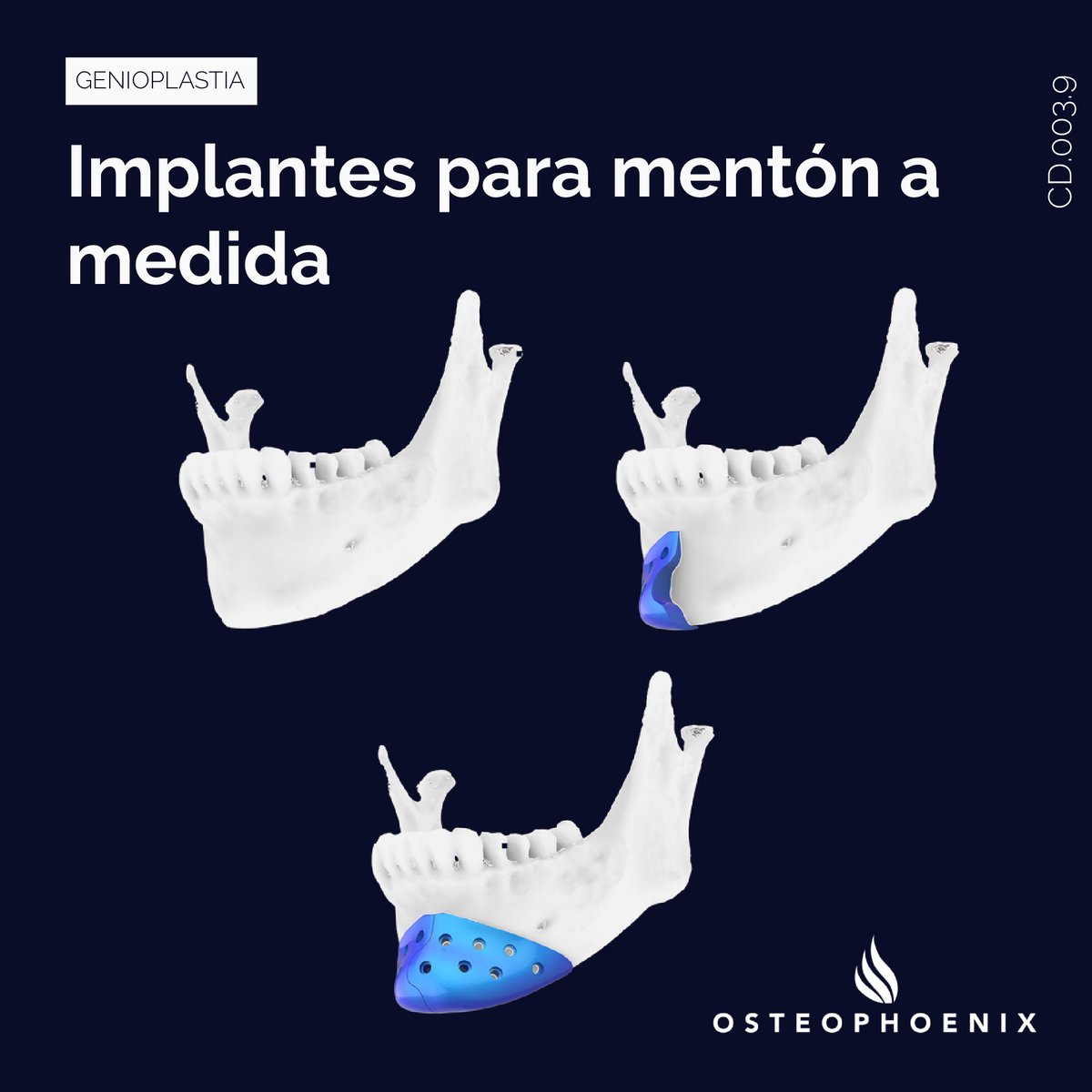OsteophoenixSL's tweet photo. La mentoplastia permite contornear el mentón para proporcionar una forma anatómica correcta. Mediante los implantes a medida de Osteophoenix se puede generar un dispositivo diseñado exclusivamente para el paciente. https://t.co/7fxM5TMoQV https://t.co/DxnkdKkfBC