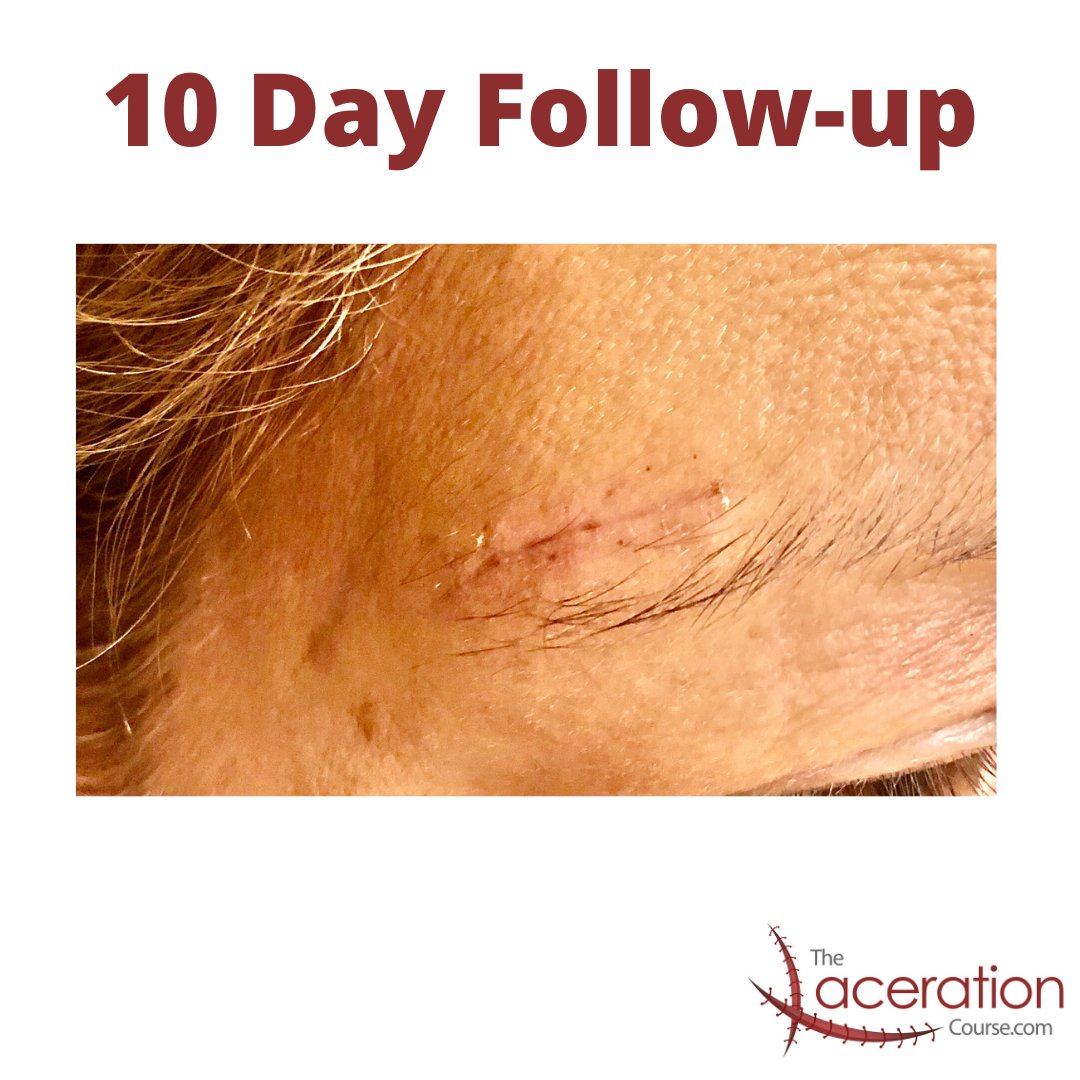 Eyebrow lacs are common. This one kept oozing so I opted for sutures instead of Dermabond. Looking good at 10 days. thelacerationcourse.com #laceration #suture
