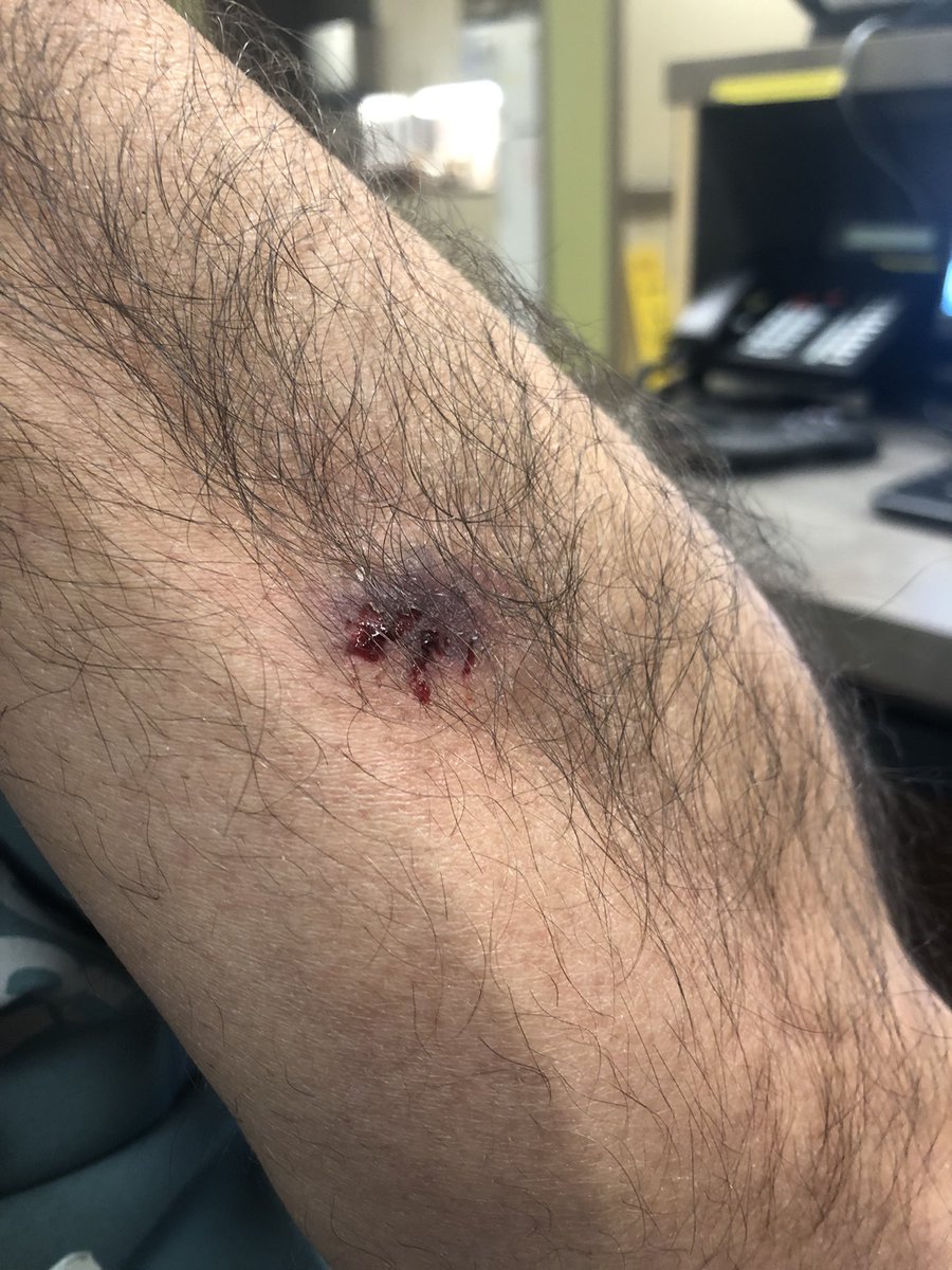 10 minutes into my shift and already bitten by a patient. Triggers blood work, paperwork, injections, prescriptions, and a delay on see a full waiting room and sick patients waiting. Thank you @ChtownPolice for responding. Just waiting to get cleaned up and back to it.