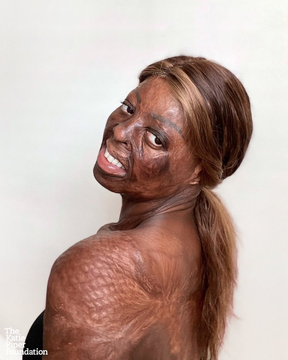 It’s incredible to see someone thrive like @Raichemederick_ has, she is such an incredible inspiration to those at the beginning of the journey. She adds ’My injuries happened as a child and I am the owner of rarest diamonds in the world on my body and these are mine’ 💎