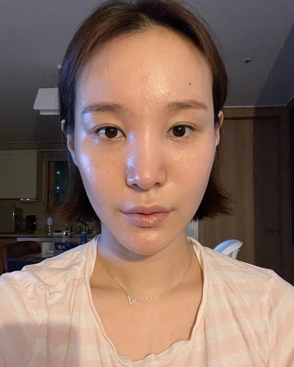 towanyantyu's tweet photo. 額縮小の症例ですけど額2センチ縮めるだけで面長ほんと改善されるから悩んでる人は本当やってほしい、韓国でやった時300万ウォンだったけど日本は高いしそこまで流行ってる手術じゃなさそうだけど、やってよかったって思える手術の中の1つ https://t.co/Wyp1SL6pHg