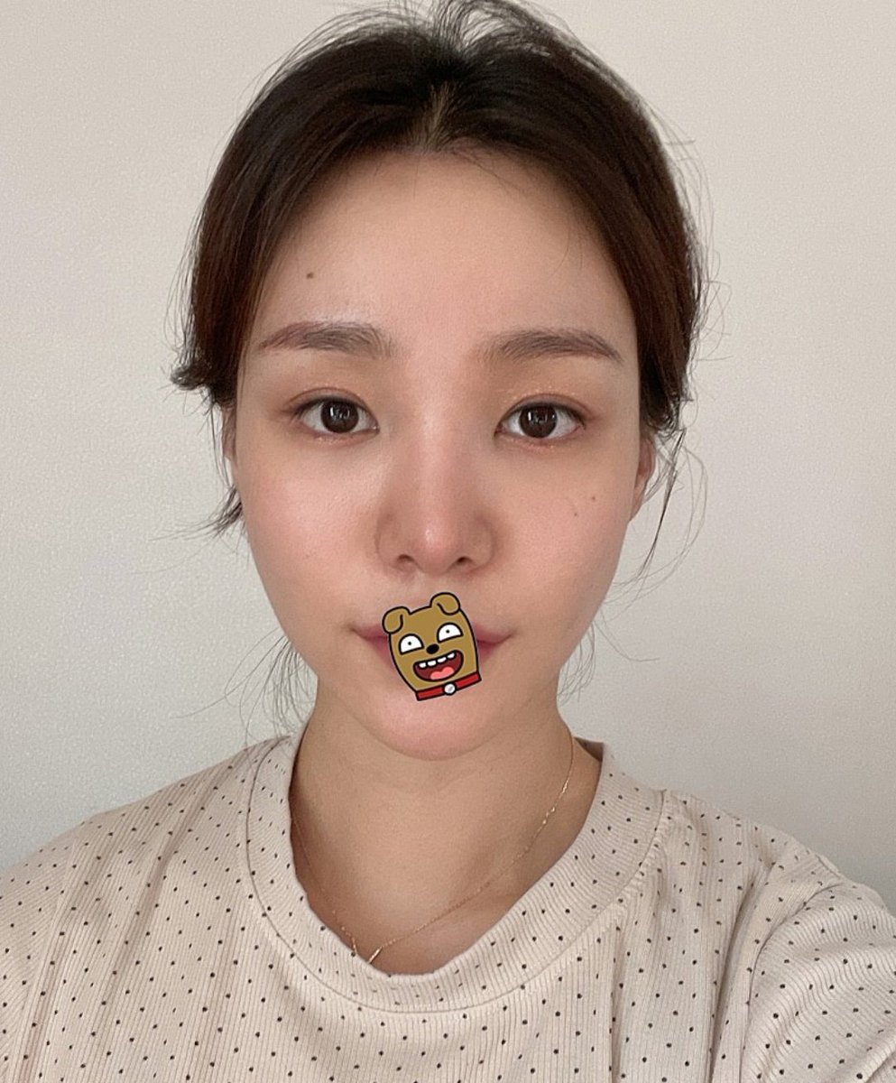 towanyantyu's tweet photo. 額縮小の症例ですけど額2センチ縮めるだけで面長ほんと改善されるから悩んでる人は本当やってほしい、韓国でやった時300万ウォンだったけど日本は高いしそこまで流行ってる手術じゃなさそうだけど、やってよかったって思える手術の中の1つ https://t.co/Wyp1SL6pHg