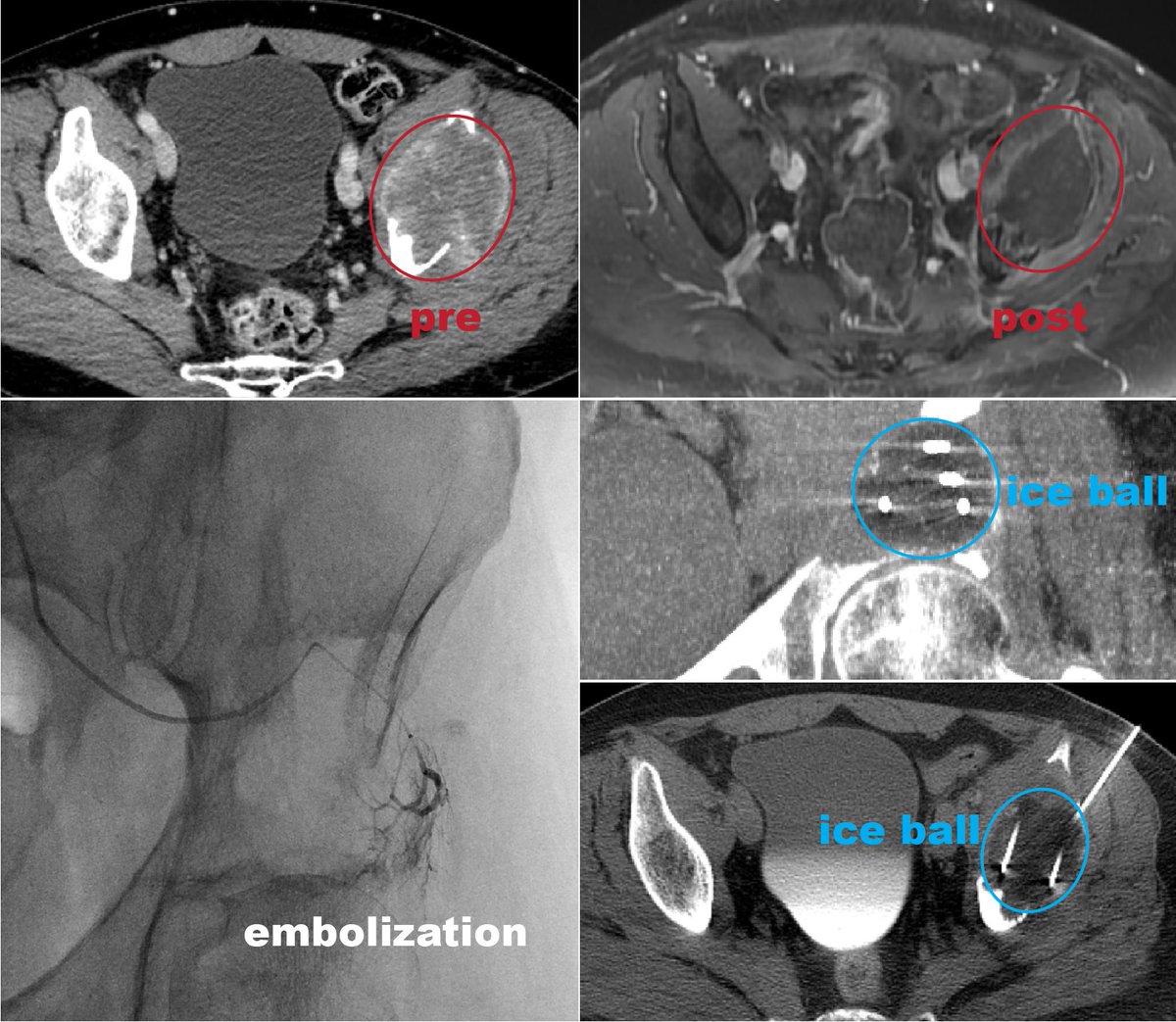 Bone metastases from #kidneycancer can be tough to treat, so when it comes to #irad therapies, I like the 'belt-and-suspenders' approach. Local control of this left pelvic metastasis was achieved with combining embolization with cryoablation in the same setting with #angioCT.