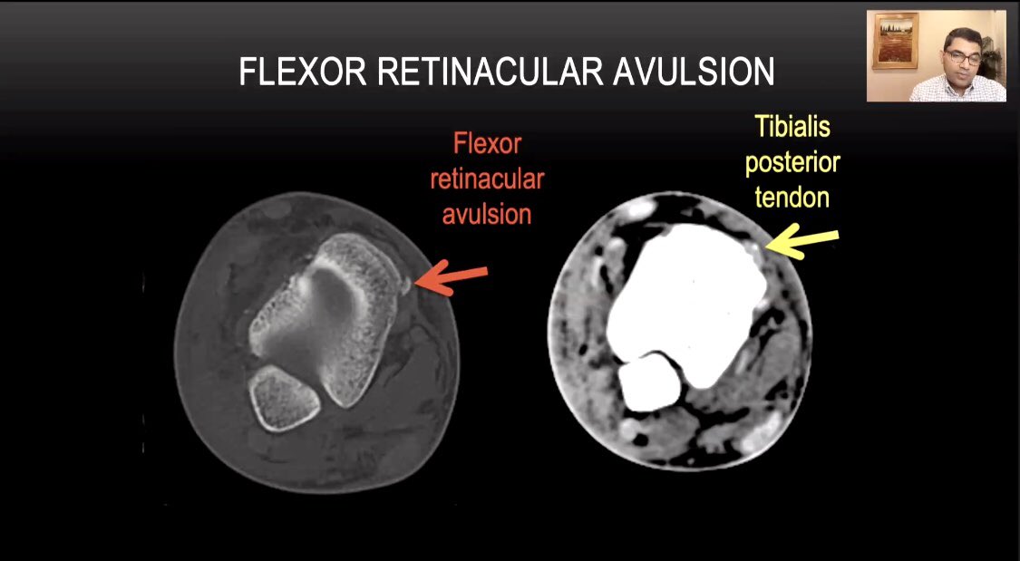 samrad77's tweet photo. Another excellent Emergency session by @MKMSKER on imaging of soft tissue injuries of ankle and how subtle # and soft tissue edema can reveal a significant injury. Avulsion # represents tip of the iceberg. 

@ASER_ERad https://t.co/vIdHbsOpFh