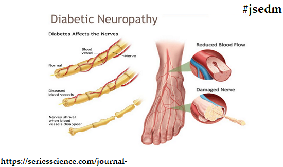 SeriesDiabetes's tweet photo. Diabetes can harm your nerves. That damage, called neuropathy, may be painful. It can happen in several ways, and they all seem to be...
Read #articles related to #Diabetic #Neuropathies here:
#openaccess #diabetes #NerveNetwork #health #awareness #jsedm
https://t.co/Ax8o5CDas3 https://t.co/i2ltlAkUCw