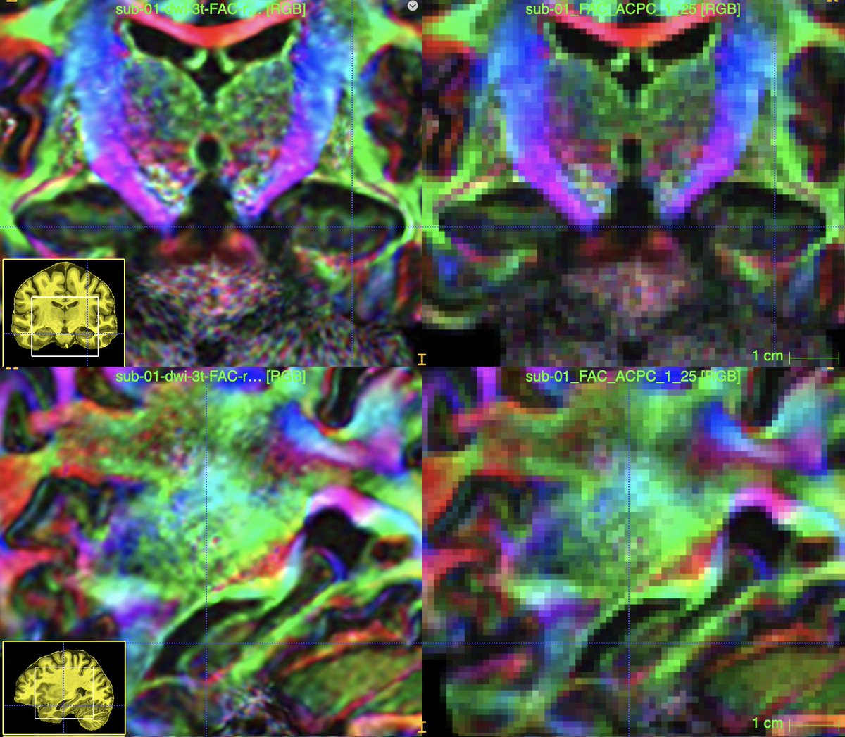 @mschira@fediscience.org (@mm_schira) on Twitter photo To settle the discussion, "Is upsampling data before analysis helpful? How can there be finer detail in the image than its initial image?" On the left supersampled average, on the right at original resolution of 1.25mm. <a href="/HumanBrainAtlas/">HumanBrainAtlas</a> <a href="/UOWASSH/">Faculty of the Arts, Social Sciences & Humanities</a> <a href="/UOW/">UOW</a> <a href="/hipposubfields/">Hippocampal Subfield Group @hipposubfields on bsky</a> To settle the discussion, "Is upsampling data before analysis helpful? How can there be finer detail in the image than its initial image?" On the left supersampled average, on the right at original resolution of 1.25mm. <a href="/HumanBrainAtlas/">HumanBrainAtlas</a> <a href="/UOWASSH/">Faculty of the Arts, Social Sciences & Humanities</a> <a href="/UOW/">UOW</a> <a href="/hipposubfields/">Hippocampal Subfield Group @hipposubfields on bsky</a>