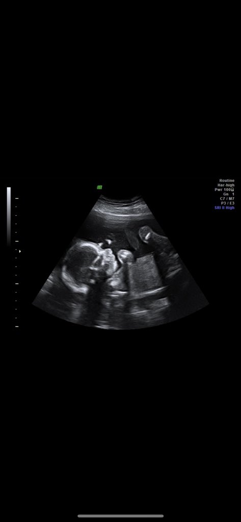kailey_blanton's tweet photo. Surprise if you don’t know yet🥰
Baby B due April 2022💙 https://t.co/pB4uhuvqsK
