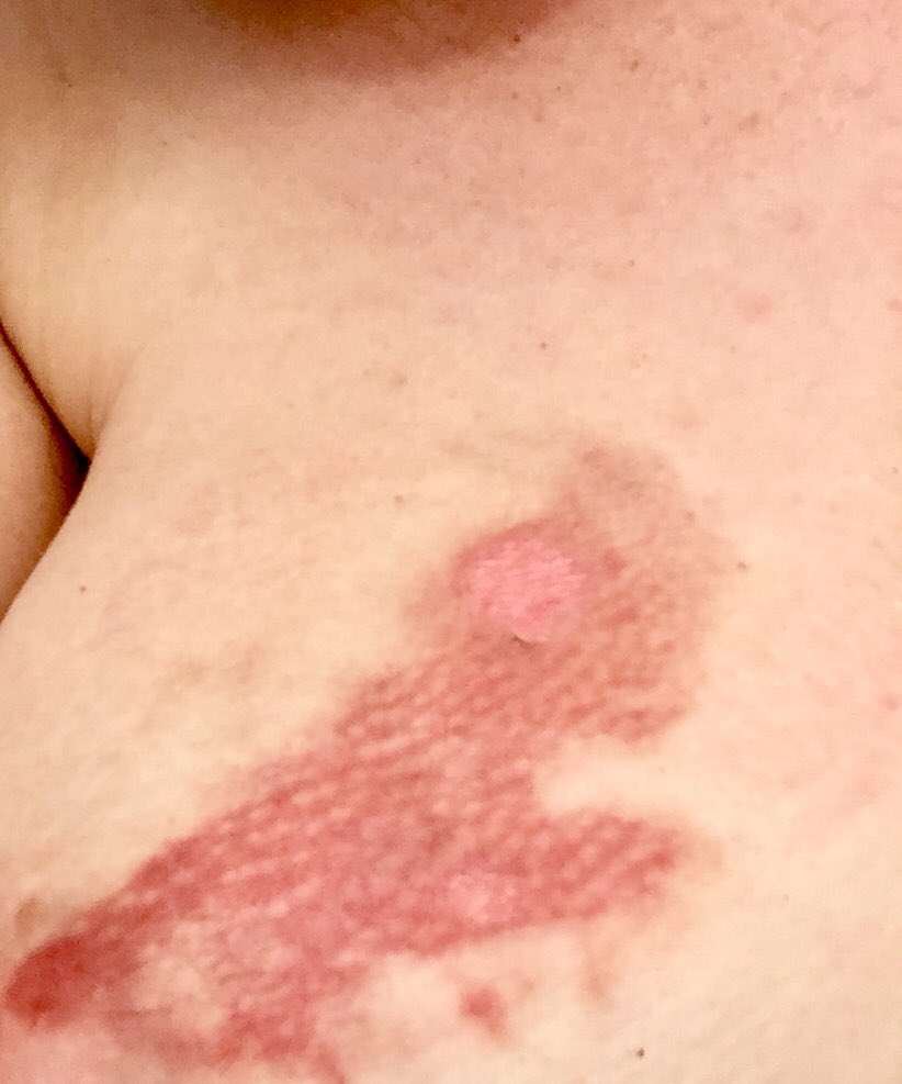 LauraCastagnini's tweet photo. One week after landing on an @etihad flight to Melbourne, still feeling the (second degree) burn... 🔥 #negligence #hotwaterbottleinjury #scalding #ouch https://t.co/CkQZRSVO0D