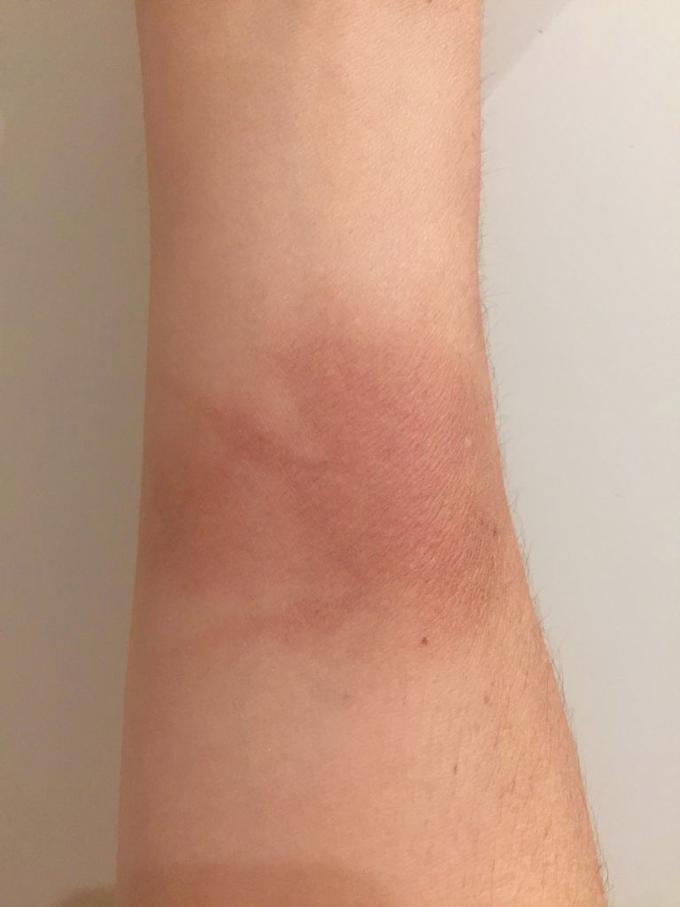 LauraCastagnini's tweet photo. One week after landing on an @etihad flight to Melbourne, still feeling the (second degree) burn... 🔥 #negligence #hotwaterbottleinjury #scalding #ouch https://t.co/CkQZRSVO0D