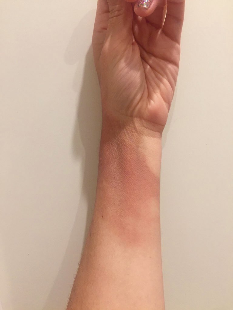 LauraCastagnini's tweet photo. One week after landing on an @etihad flight to Melbourne, still feeling the (second degree) burn... 🔥 #negligence #hotwaterbottleinjury #scalding #ouch https://t.co/CkQZRSVO0D