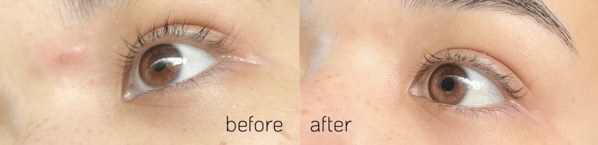 mmytype_'s tweet image. เหตุเกิดจากสิวเจ้าปัญหาที่รักษาเองก็ไม่หายสักที แล้วไปเจอรีวิวแอพของคุณหมอผิวหนัง ชื่อ BlossomApp เค้ามีปรึกษาดูแลผิวรักษาสิว ผ่านแอพ ตอบโจทย์มาก แล้วไม่ต้องกลัวโดนขายคอร์สอ่ะ555 คุณหมอถามละเอียดมาก ซูมดูสิวเราแบบดูแล้วดูอีกอะ สิวตัวปัญหาของเรามันหายจริงนะ ต่อ👏🏻 #แอพหมอสิวผิวปัง