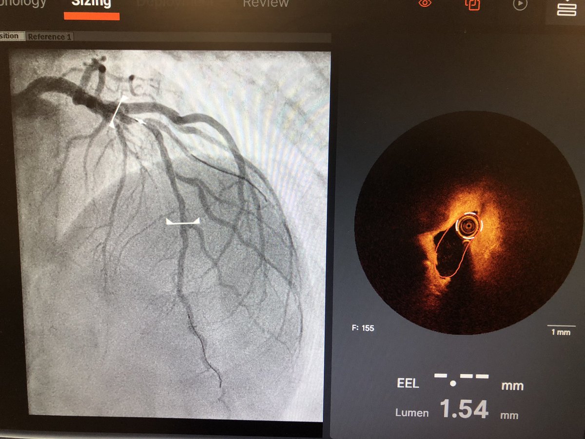 Abdul Mozid (@ammozid) on Twitter photo Nice coregistration OCT case with Ultreon software, precision PCI <a href="/cardiorespLTHT/">Cardio-Respiratory - LTHT</a> <a href="/LTHTrust/">LTHT</a> <a href="/sparfrey/">Shane Parfrey</a> <a href="/mattbooth187/">Matt Booth</a> <a href="/JonathanDWood1/">Jonathan D Wood</a> Nice coregistration OCT case with Ultreon software, precision PCI <a href="/cardiorespLTHT/">Cardio-Respiratory - LTHT</a> <a href="/LTHTrust/">LTHT</a> <a href="/sparfrey/">Shane Parfrey</a> <a href="/mattbooth187/">Matt Booth</a> <a href="/JonathanDWood1/">Jonathan D Wood</a>