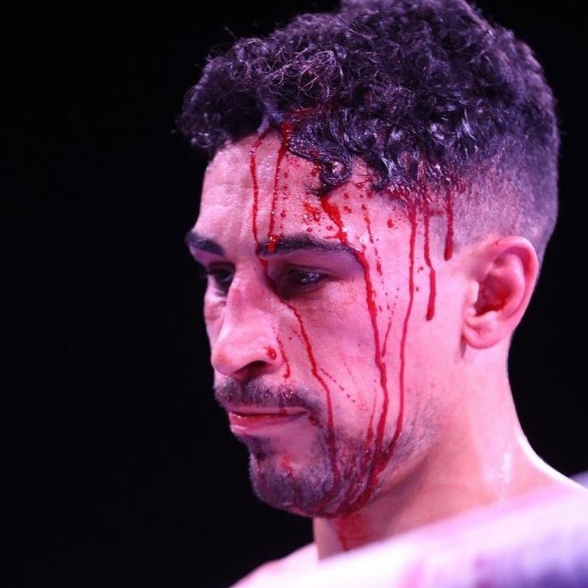 JGNXTGEN's tweet photo. Our man will be back stronger than ever, we look forward to competing for the European title! @_JordanGill
#unlucky #boxing #badcut #roadtorecovery #matchroom #matchroomboxing #boxer #letsgo #letsgojordan https://t.co/ClXBKaFR4U