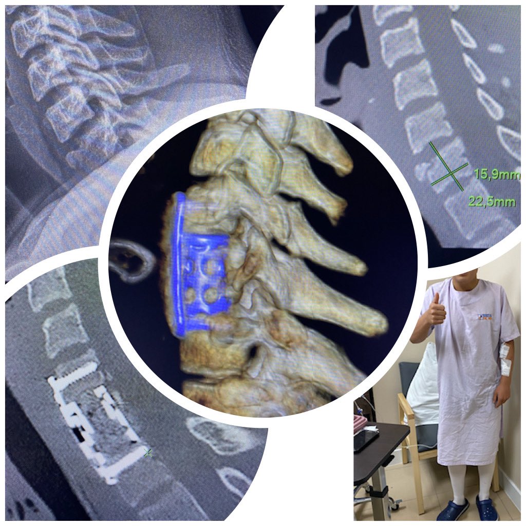 pterion77's tweet photo. Paciente de 17 años que sufre accidente de tránsito, fractura -luxación de columna cervical , se
realiza Corpectomía de C7
con resultado favorable y alta al siguiente día @HospitaldelRio #columna #cervical #spine
#corpectomy @pablopenatapia https://t.co/NLCc3CqRdC