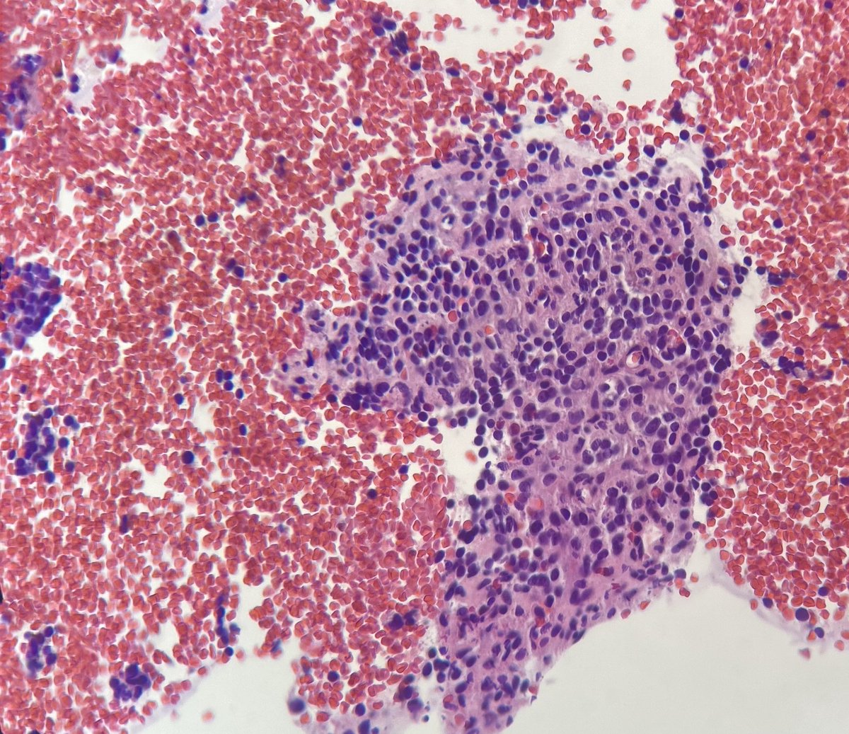 CytologyEFCS's tweet photo. IMPORTANT!⚠️🦾☑️Cell blocks represent a valuable tool in modern #cytopathology for #ICC and #molpath.European Federation of Cytology Societies w/ @ukneqascpt prepared this survey to gather information about #cellblocks

🙏🏼Thank you for your answers!! 

➡️https://t.co/ainzi1CyOG https://t.co/Gue6rbvs4V