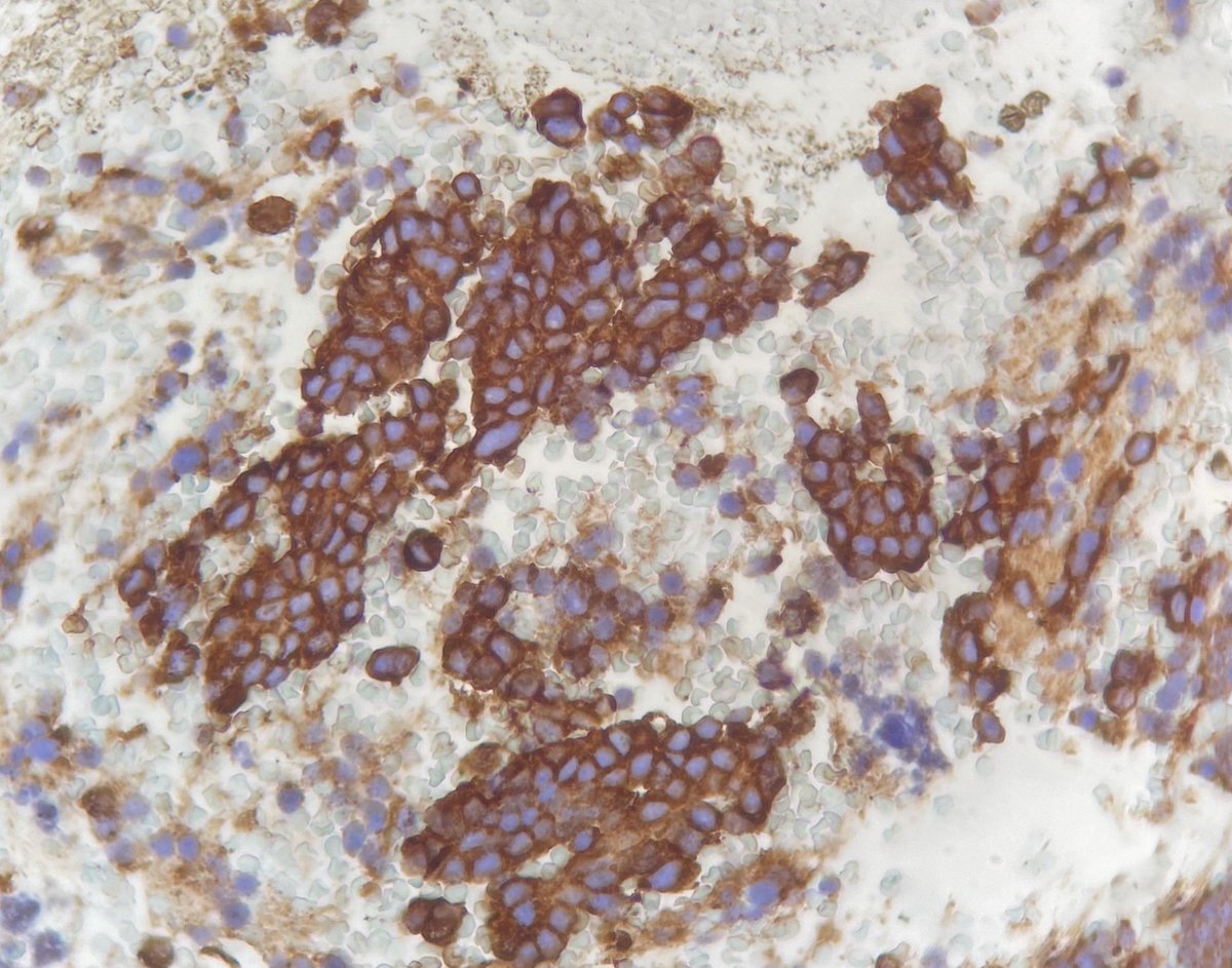 CytologyEFCS's tweet photo. IMPORTANT!⚠️🦾☑️Cell blocks represent a valuable tool in modern #cytopathology for #ICC and #molpath.European Federation of Cytology Societies w/ @ukneqascpt prepared this survey to gather information about #cellblocks

🙏🏼Thank you for your answers!! 

➡️https://t.co/ainzi1CyOG https://t.co/Gue6rbvs4V