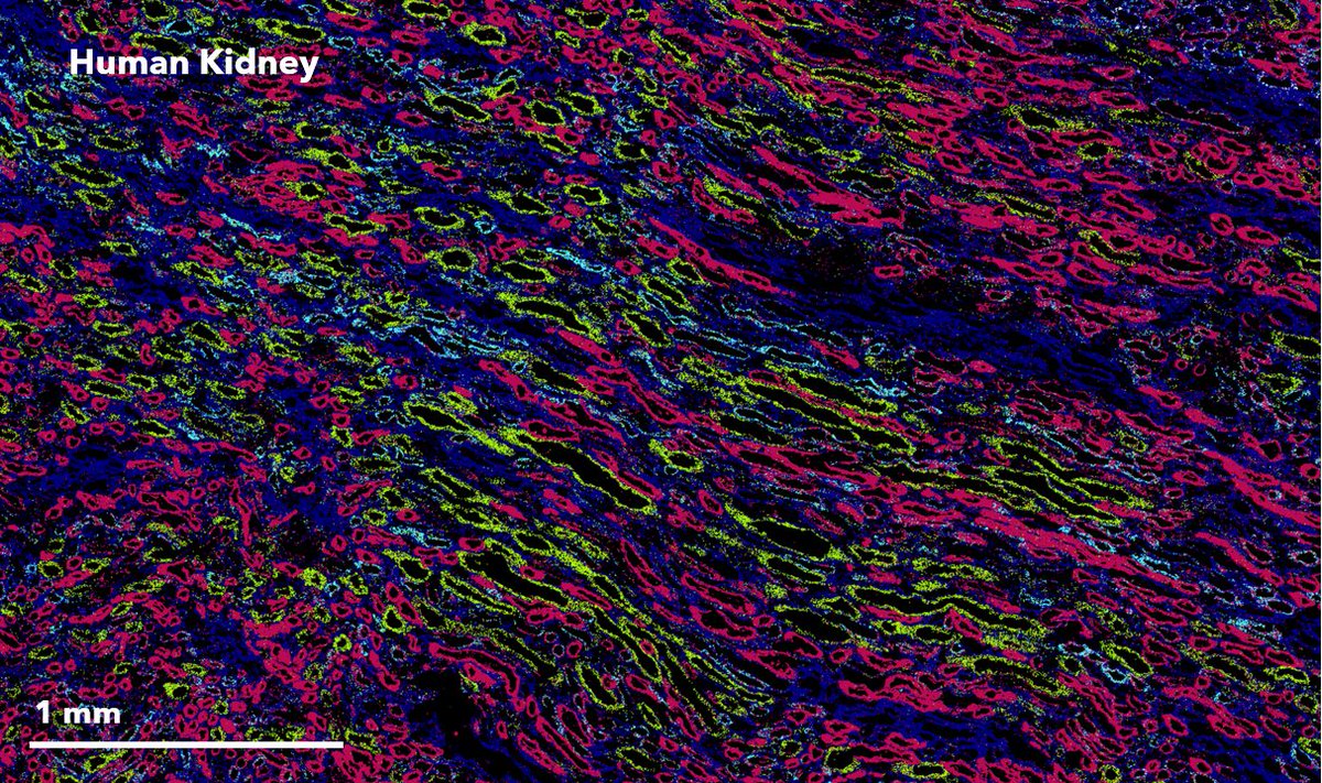 vizgen_inc's tweet image. Check out this striking #MERSCOPEmasterpiece! The 7 genes in this #DataImage can be used to help identify different classes of tubules in the human kidney. AQP1-blue, CLDN8-yellow, EPCAM-yellow, GPX3-blue, SLC34A2-cyan, UMOD-red, VIM-blue
#SciArt #MERSCOPE #MERFISH