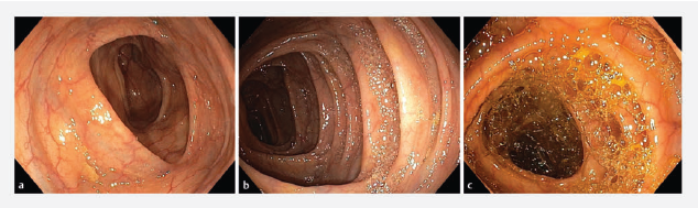 endoscopyjrnl's tweet photo. The Colon Endoscopic Bubble Scale (#CEBuS): a two-phase evaluation study
by Filipe Taveira, Cesare Hassan, Michal F. Kaminski et al.
Read more here: https://t.co/IsYj9HbXtI https://t.co/ZkTmjIWAJx