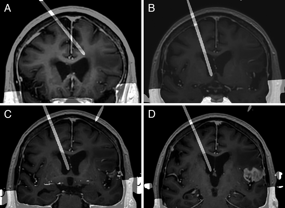 TheJNS's tweet image. #NeurosurgicalFocus The effect of augmented reality on the accuracy and learning curve of external ventricular drain placement thejns.org/focus/view/jou…