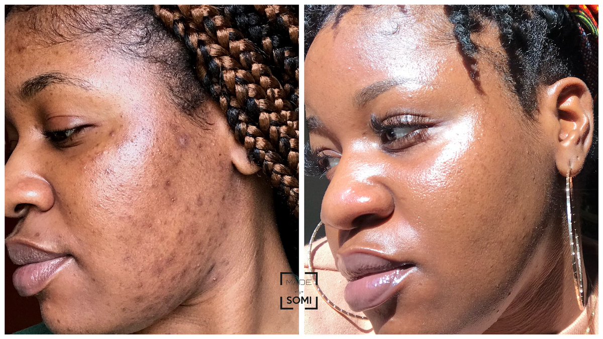 iamDrSOMI's tweet photo. This is what @MadebySOMI natural skincare products, 1 gallon of water/day, eating clean and minding your business does ✨ https://t.co/IvnrWq9R70