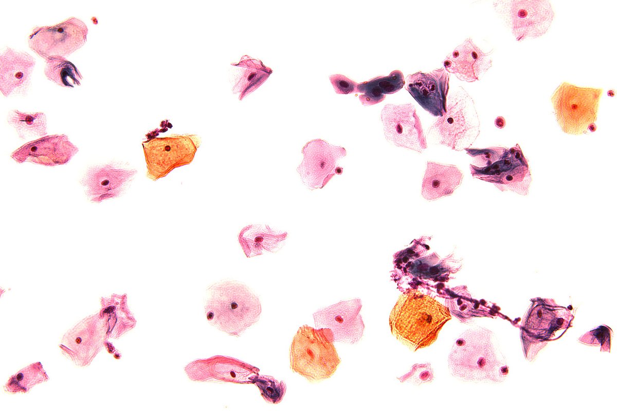 CnicPhday's tweet photo. Citological papanicolau smear showing solitary superficial and basal cells with no atipical signs, benign keratinization #virtualCNICPhday21 #PRV https://t.co/lHqx7zq3DG