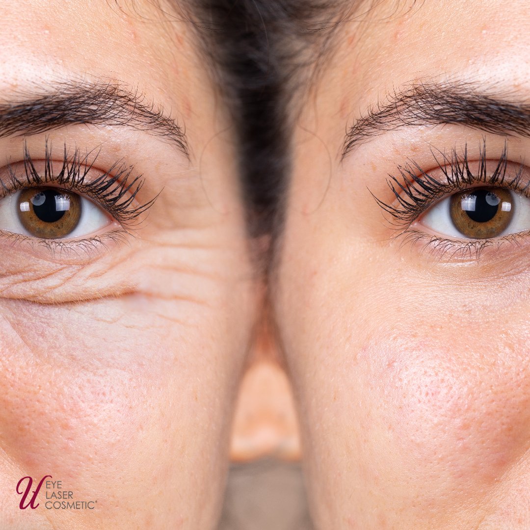 uelc_ca's tweet photo. You may be wondering whether OHIP will cover your eyelid surgery. It's possible, but only under limited circumstances. https://t.co/SoUs2XxOEd #UELC #blepharoplasty #bleph #eyelidsurgery https://t.co/K8HoMSP9px