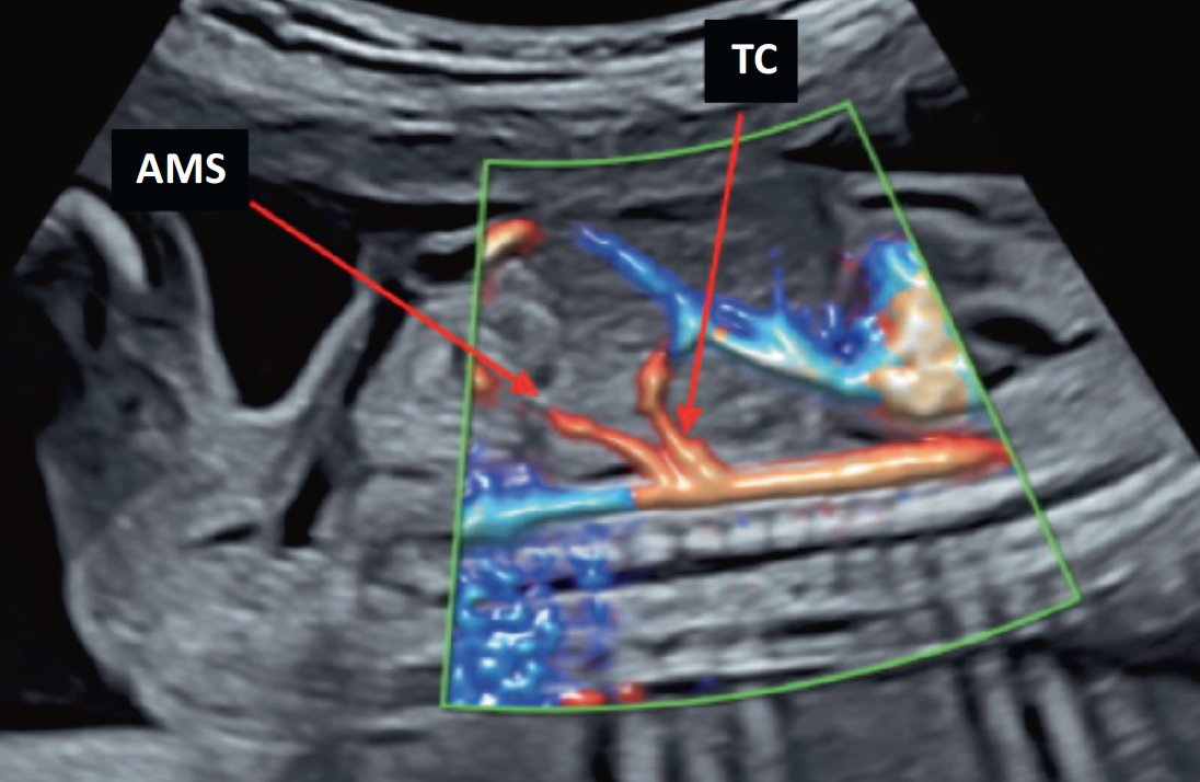 RevueVision's tweet photo. La vascularisation abdominale fœtale et ses anomalies https://t.co/S5yxz0JgT4 https://t.co/g2WPj8aZSz