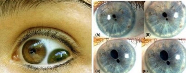 поликория аномалия глаз. лю чунь глаза. поликория радужной оболочки. поликория аномалия глаз. двоение зрачка.