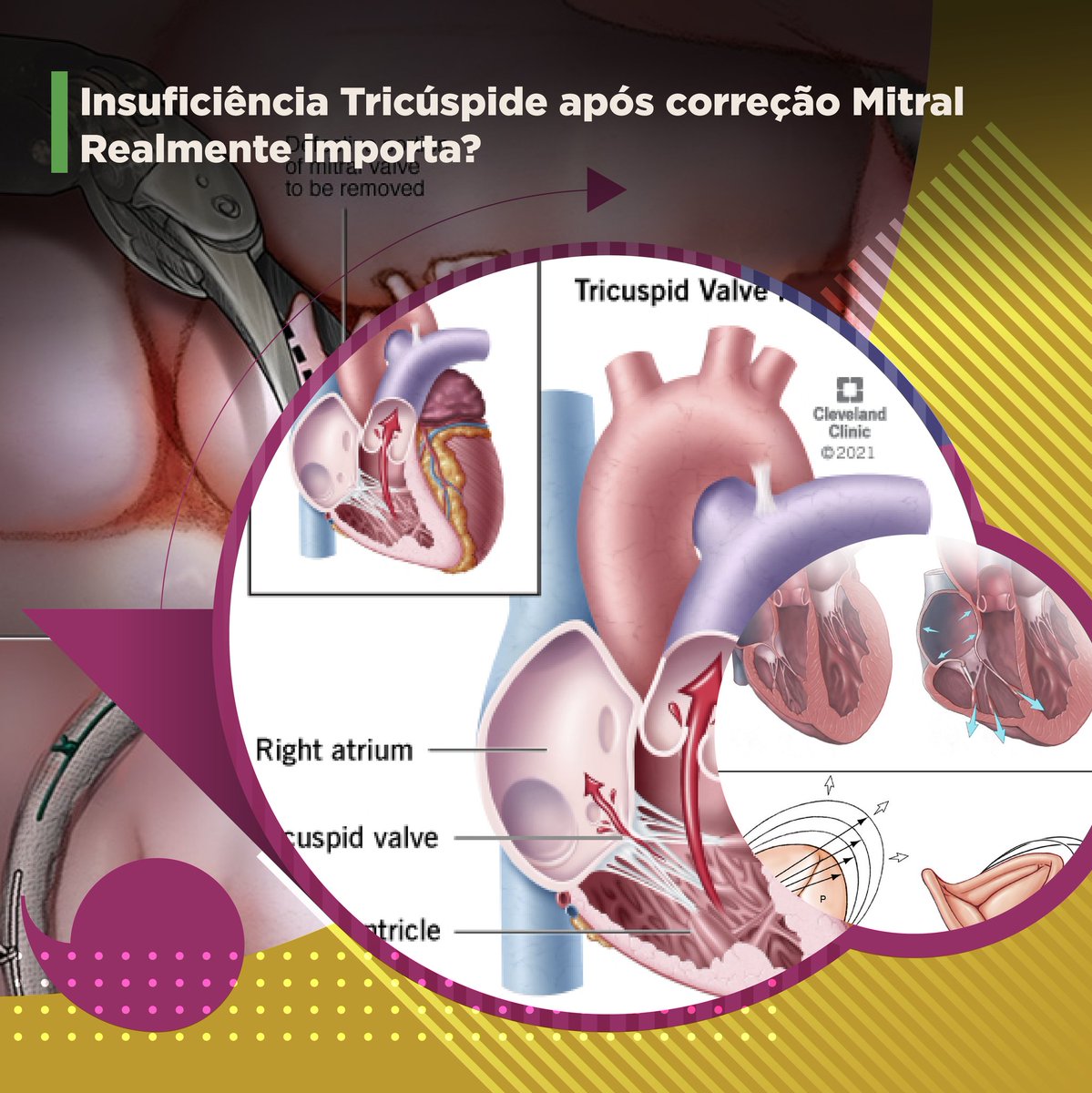 Tricuspid regurgitation is a great challenge, especially when it appears in isolation.
.
Some publications on the joint approach support the guidelines, but would they be consolidated?
.
Go to thevalveclub.com.br