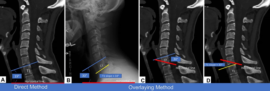 TheJNS's tweet photo. #OnlineFirst: What is the most accurate substitute for an invisible T1 slope in cervical radiographs? A comparative study of a novel method with previously reported substitutes. https://t.co/cAR9Bc6lNy https://t.co/8caN2t9TKu