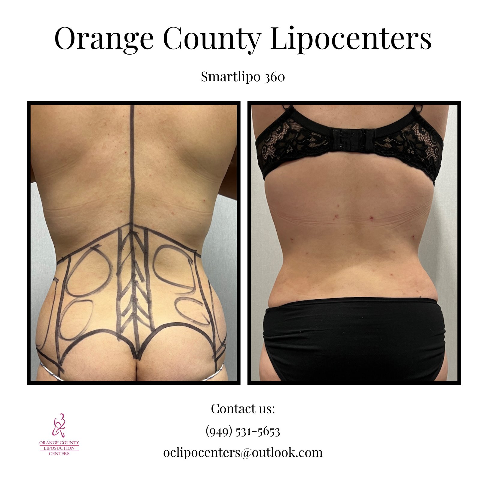 Los Angeles Liposuction Centers on X: Great transformation from this female  patient 5 weeks after Smartlipo 360. Smartlipo 360 includes 6 areas, upper  and lower abdomen, each love handle and each side