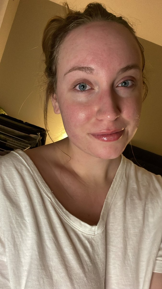 glowwitherinn's tweet photo. PS, Social Media is fake ✌🏻 it’s cool to have pimples https://t.co/6KQ3UBmWqe