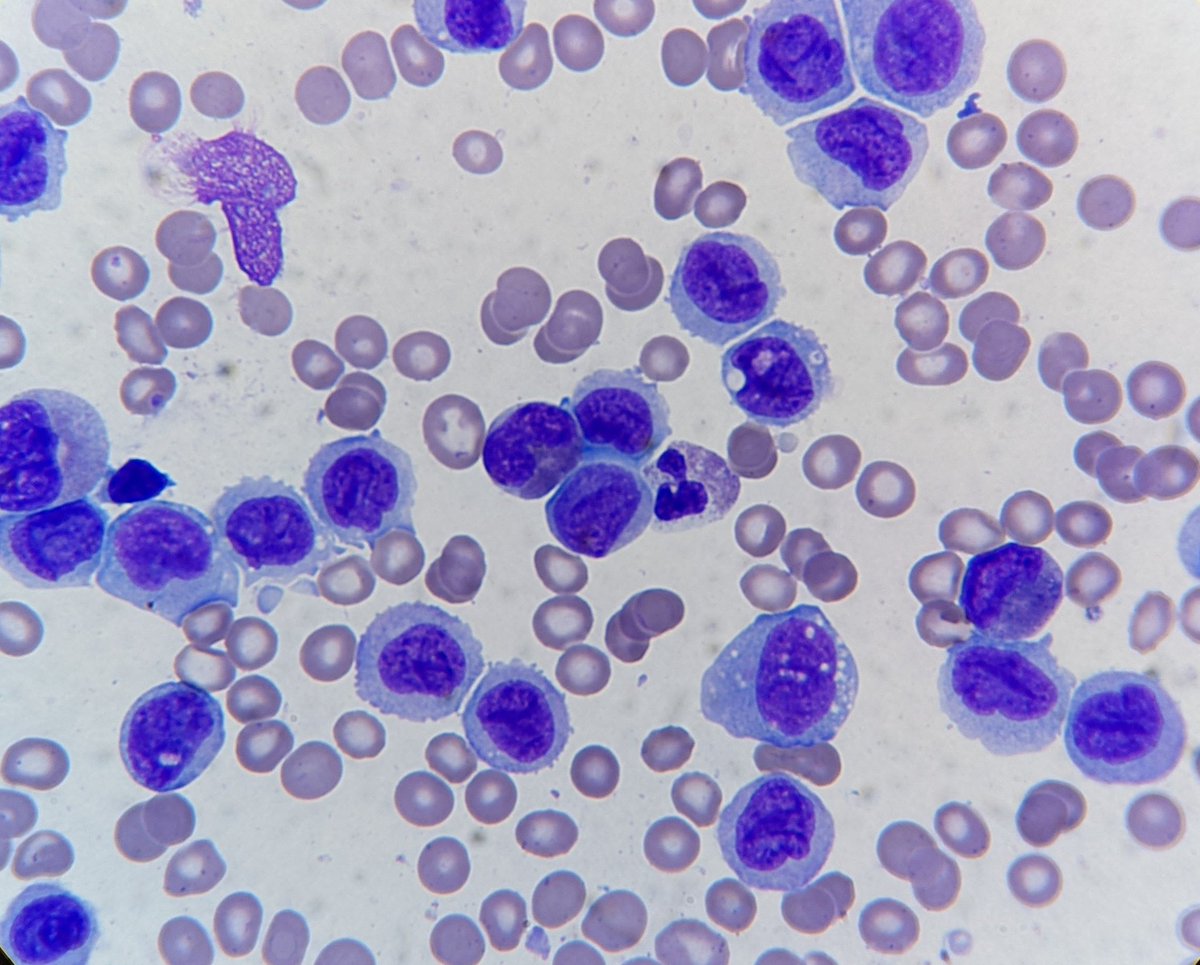 mark_girton's tweet photo. 70 yo M peripheral blood.  Thoughts? https://t.co/mEcRhpOuvD