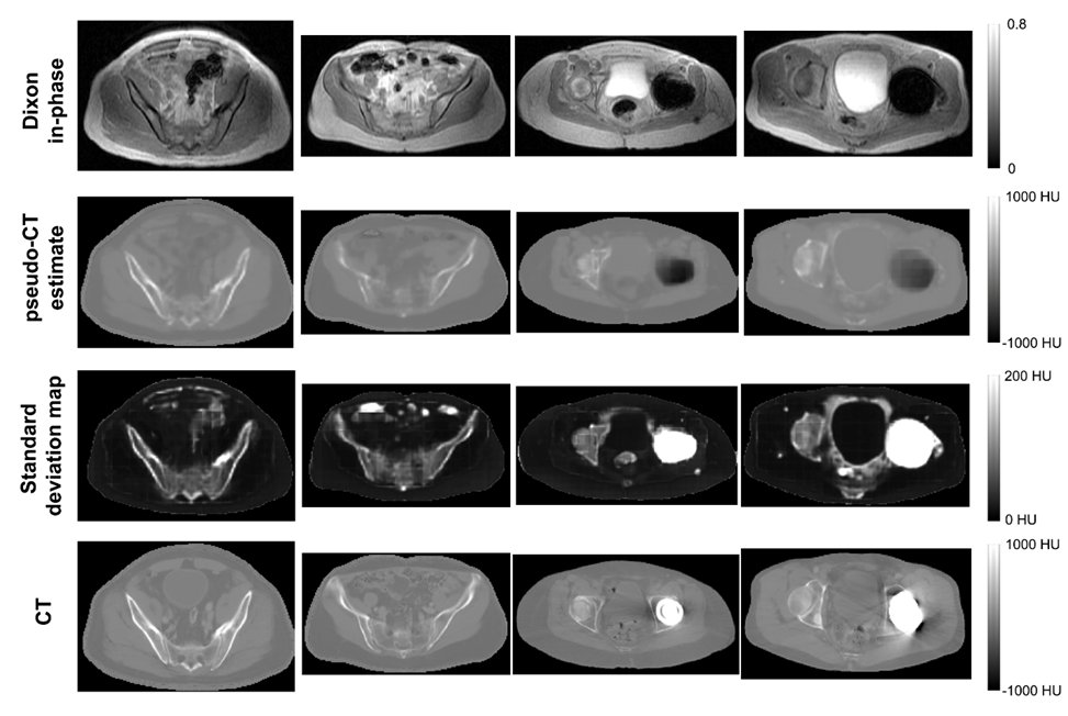 Pulling out all the stops for #PETMR reconstruction
- #Bayesian #DeepLearning for MRI-to-CT, producing attenuation and **uncertainty** estimates(!)
- Combine with TOF-PET data in MLAA synergistic recon
- accurate even w implants
@thomashopemd @UCSFimaging
ieeexplore.ieee.org/document/95601…