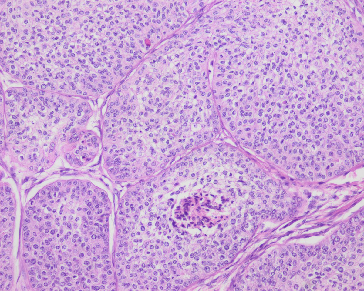 Высокодифференцированная метастазы. Низкодифференцированная аденокарцинома гистология. Липосаркома патологическая анатомия. Высокодифференцированная метастазы. Аденокарцинома цитология.